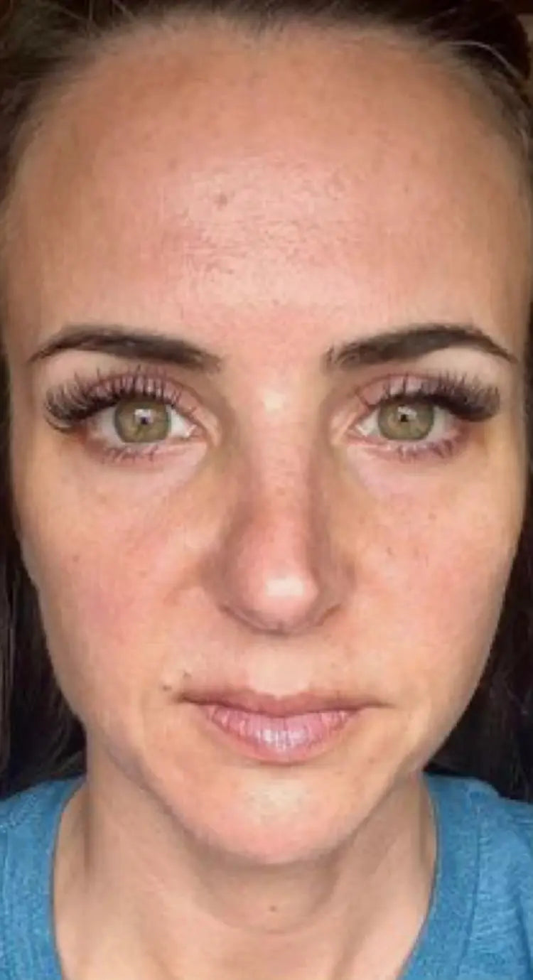 "Gros plan sur l'amélioration du grain de peau d'une cliente après un traitement au microneedling AYLI SKIN."