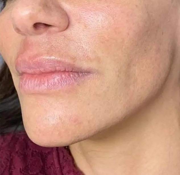 "Zoom sur le grain de peau d'une cliente après l'utilisation du microneedling AYLI SKIN pour réduire les imperfections."