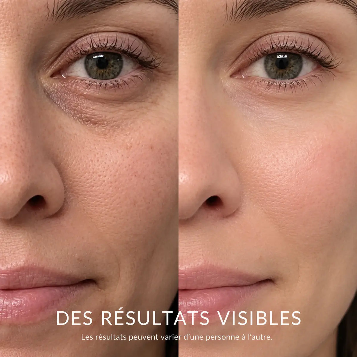 Avant et après AYLI LUMINA : cernes et ridules du contour des yeux
