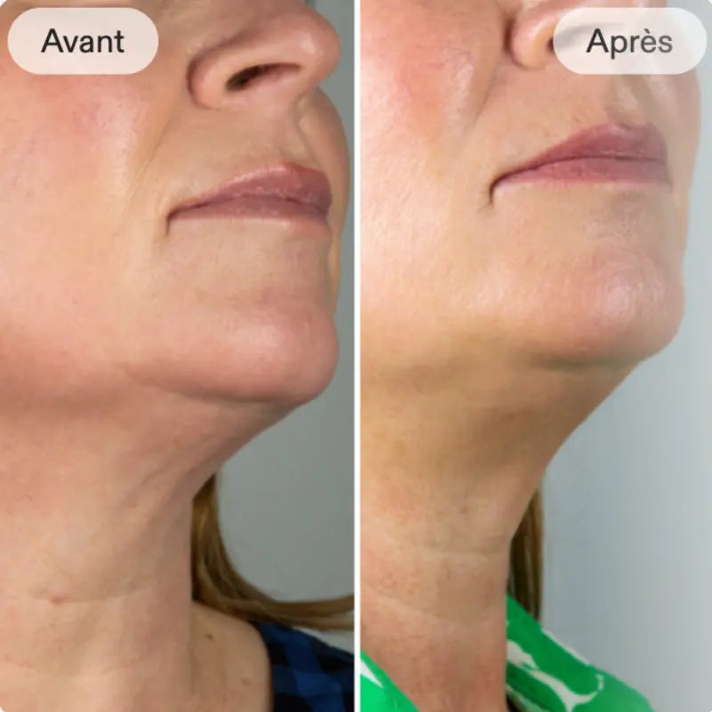 "Comparaison avant et après montrant une réduction visible du relâchement cutané et un raffermissement de la zone du cou et du menton après utilisation du sculpteur facial."